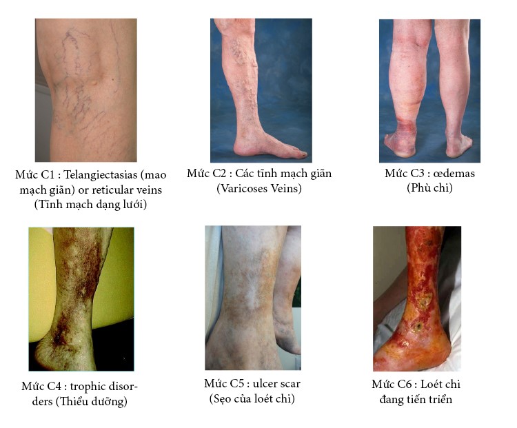 Bệnh giãn tĩnh mạch chân khám ở đâu? Bệnh giãn tĩnh mạch chân khám ở đâu?
