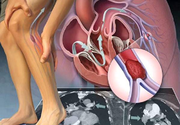 Bệnh lý mạch máu: dấu hiệu mơ hồ nhưng có thể gây tàn phế