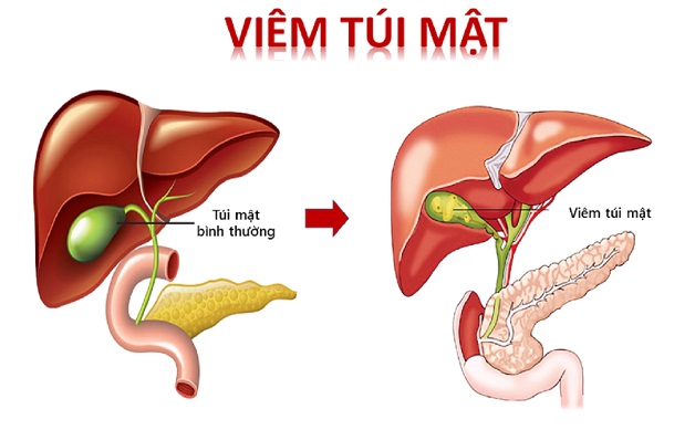 Bệnh viêm túi mật và cách nhận biết Bệnh viêm túi mật và cách nhận biết