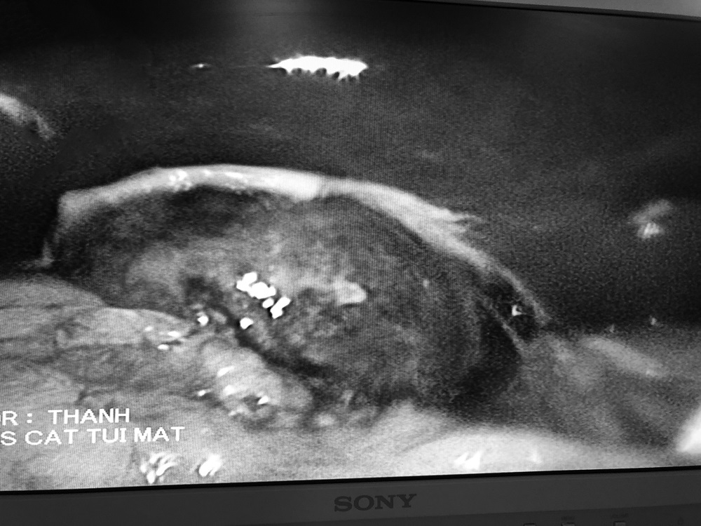 Bệnh viêm túi mật và cách nhận biết Bệnh viêm túi mật và cách nhận biết