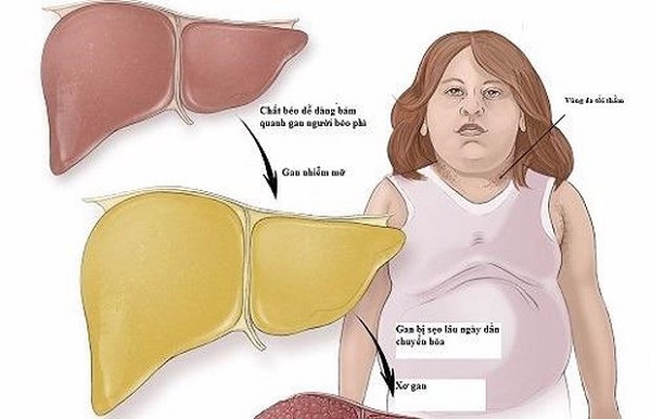 Béo phì và tiểu đường dẫn đến ung thư gan 1 beo phi va tieu duong dan den ung thu gan 66f82af514793