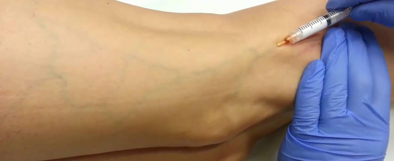 Giãn tĩnh mạch Giãn tĩnh mạch