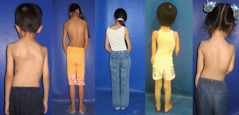 gù vẹo cột sống học đường làm sao phòng ngừa gù vẹo cột sống học đường làm sao phòng ngừa