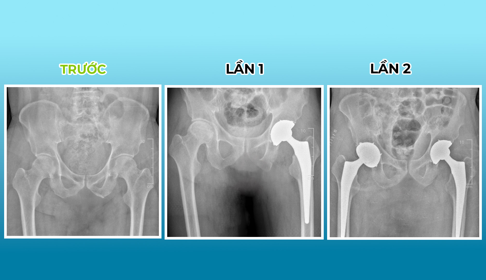 Hai lần phẫu thuật thay khớp háng nhân tạo toàn phần thành công 