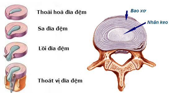 hai phuong phap dieu tri thoat vi dia dem pho bien 66f81e2870f9c
