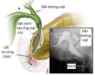huu ich thu thuat ercp trong noi soi mat tuy 66f81c05cf092