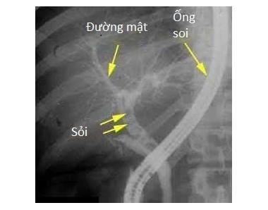 huu ich thu thuat ercp trong noi soi mat tuy 66f81c060e55d