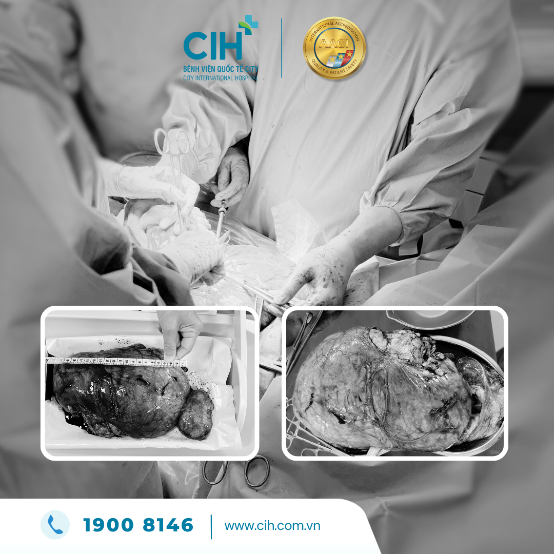 Khối u siêu to 1,5 kg chèn ép thai nhi - phẫu thuật thành công mổ sih và bóc tách