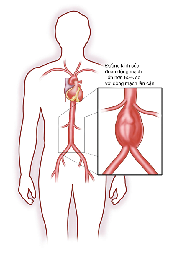 Làm sao để phát hiện phình động mạch chủ bụng