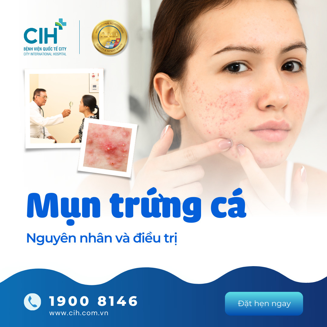 Mụn trứng cá nguyên nhân và cách điều trị  Mụn trứng cá nguyên nhân và cách điều trị