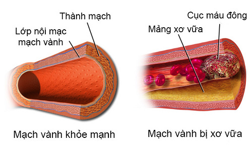 Nguy cơ tử vong vì xơ vữa động mạch vành