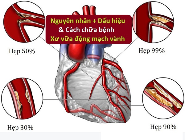Nguy cơ tử vong vì xơ vữa động mạch vành
