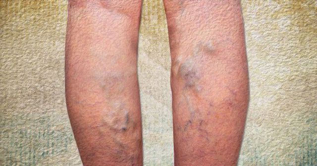 Những lời khuyên bổ ích cho bệnh nhân suy giãn tĩnh mạch Những lời khuyên bổ ích cho bệnh nhân suy giãn tĩnh mạch