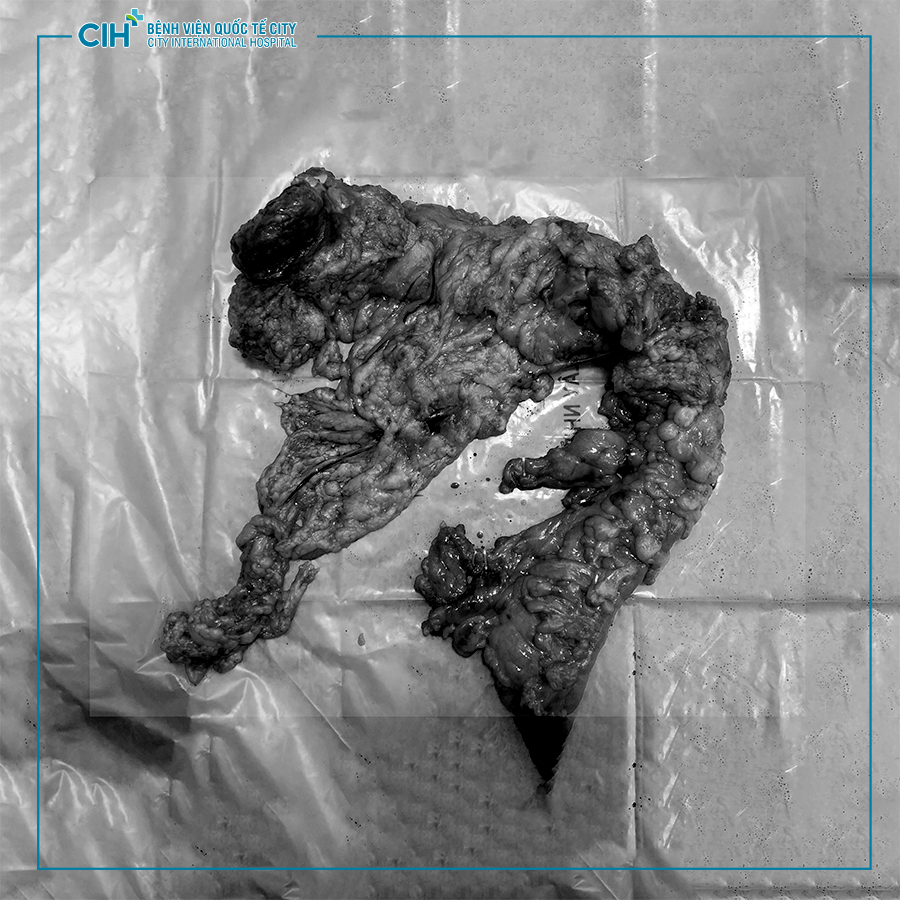 Phẫu thuật cắt nửa đại tràng phải qua nội soi ổ bụng cho bệnh nhân nam 37 tuổi