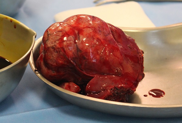 Phẫu thuật cắt u gan ở bệnh nhi không truyền máu hiếm gặp 4 phau thuat cat u gan o benh nhi khong truyen mau hiem gap 66f82baf0d646