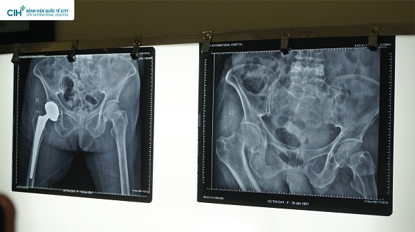 Bệnh nhân Võ Thị C sau mổ thay khớp háng nhân tạo, đã tự đi lại trong phòng và tự ra ngồi ghế mà không cần trợ giúp của người khác