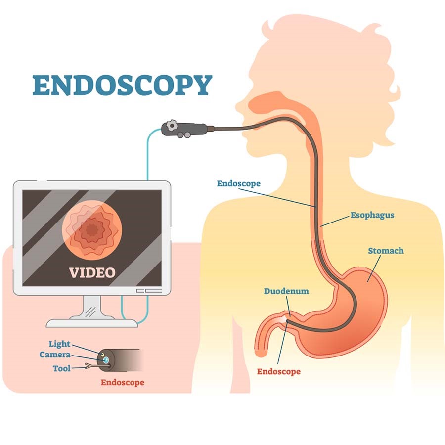 Phòng tránh và phát  hiện sớm ung thư dạ dày