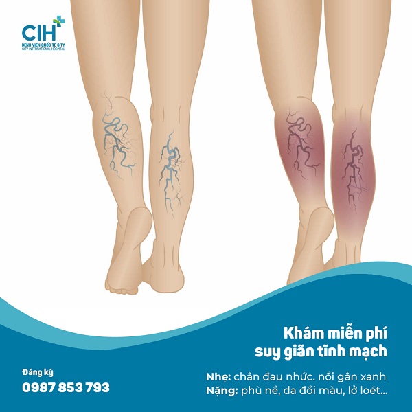 Suy giãn tĩnh mạch - Nỗi lo của những người lớn tuổi 1 suy gian tinh mach noi lo cua nhung nguoi lon tuoi 66f81a140f715