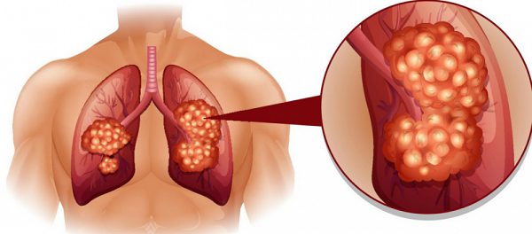 tam soat de phat hien som benh ung thu phoi 66f82c4a508f6