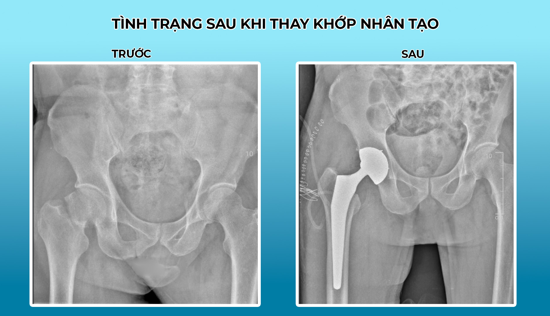 Thay khớp háng nhân tạo toàn phần không đau 