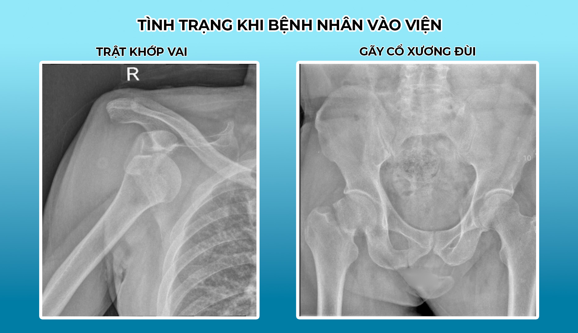 Thay khớp háng nhân tạo toàn phần không đau 