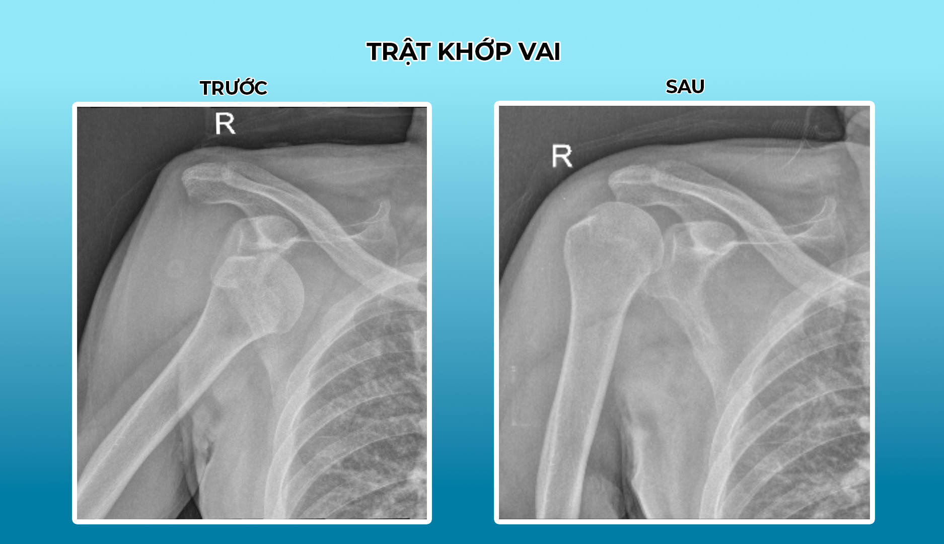 Thay khớp háng nhân tạo toàn phần không đau 