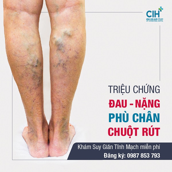 Thứ 3 và thứ 6 khám bệnh lý mạch máu miễn phí 1 thu 3 va thu 6 kham benh ly mach mau mien phi 66f81afbed419