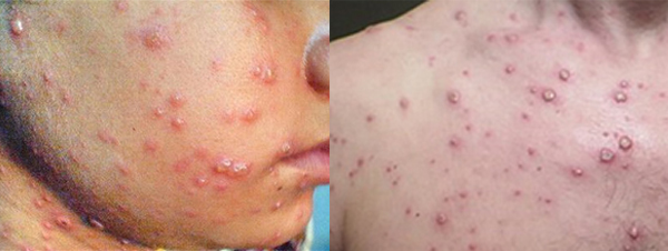 thuy dau nhung luu y de phong ngua bien chung va lay nhiem 66f82b8fd0c7d