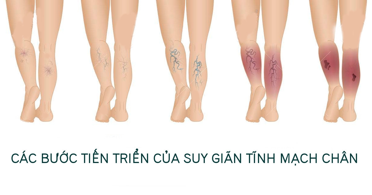Tình trạng giãn tĩnh mạch nông, suy tĩnh mạch mạn tính Tình trạng giãn tĩnh mạch nông, suy tĩnh mạch mạn tính