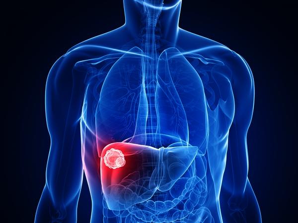 Gan bị viêm không được điều trị kịp thời lâu ngày sẽ dẫn đến suy gan