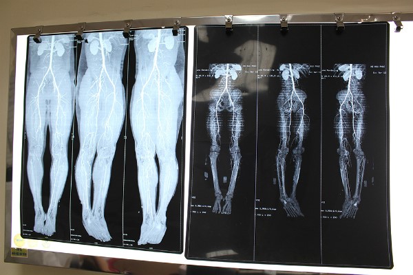 Chàng trai suýt mất chân vì tắc động mạch chi Chàng trai suýt mất chân vì tắc động mạch chi