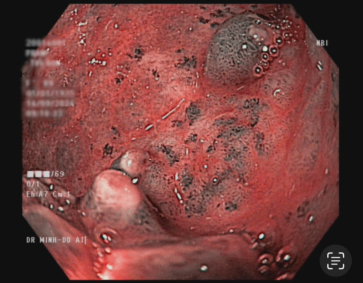 Hình ảnh nội soi cho thấy bệnh nhân mắc bệnh GAVE hiếm gặp